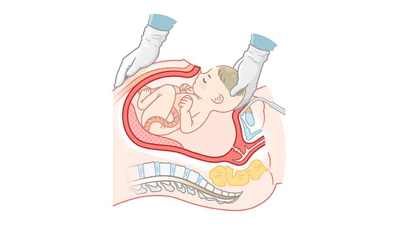 ■帝王切開とは?