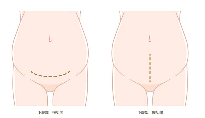 ・帝王切開の傷は2パターン?